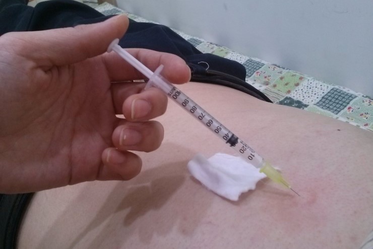 소화불량의 봉독치료