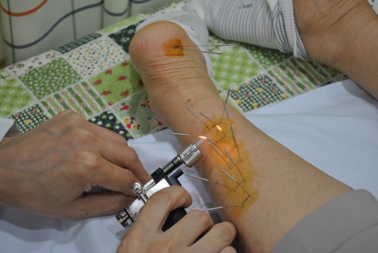 아킬레스에 화침 시술 장면