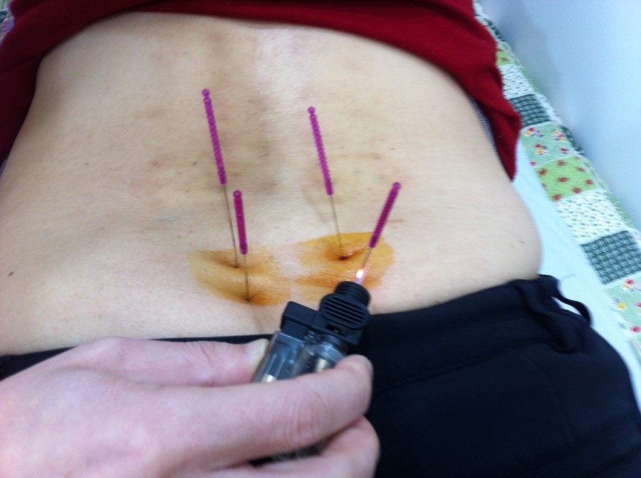 요추부위 화침 시술