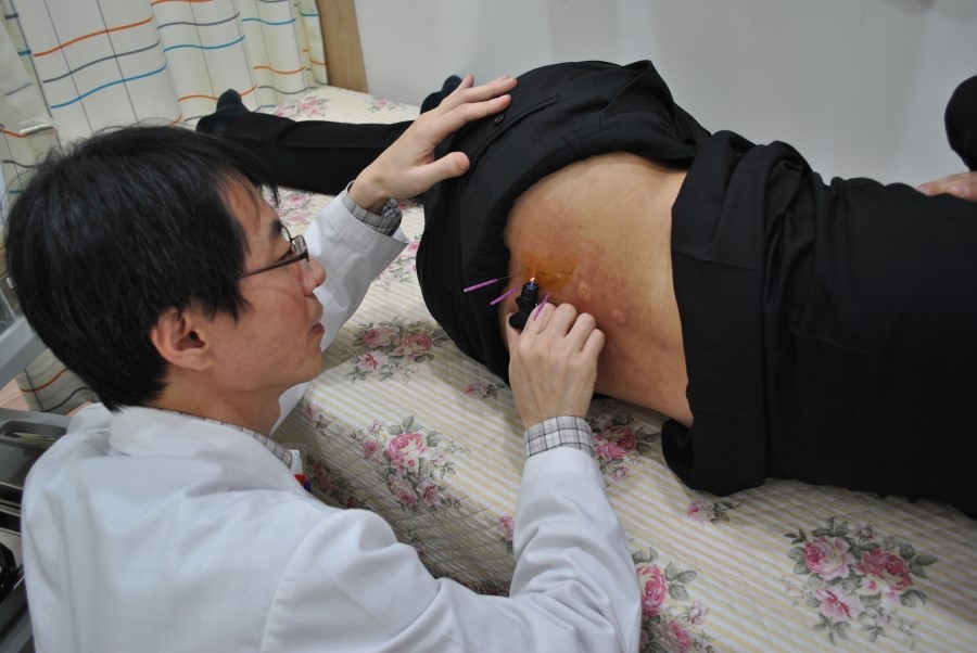 허리 천장관절 아피톡신 봉독 및 화침 시술