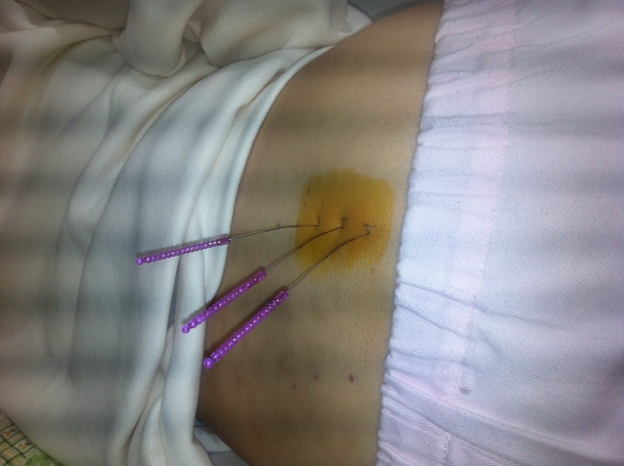 천장관절 화침 시술 3